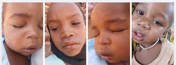 تفشٍ خطير للحصبة في الطويشة ولاية شمال دارفور وتحذيرات من كارثة إنسانية وشيكة