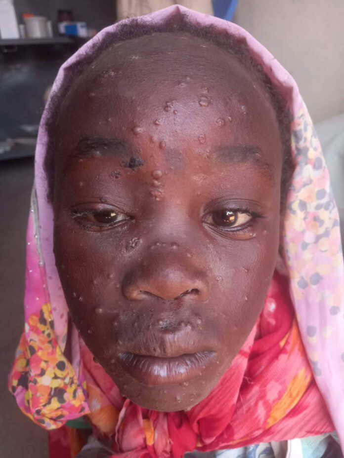 حركة تحرير السودان تطلق نداءً عاجلاً بعد تفشي جدري القردة في “دائرة ديرا”